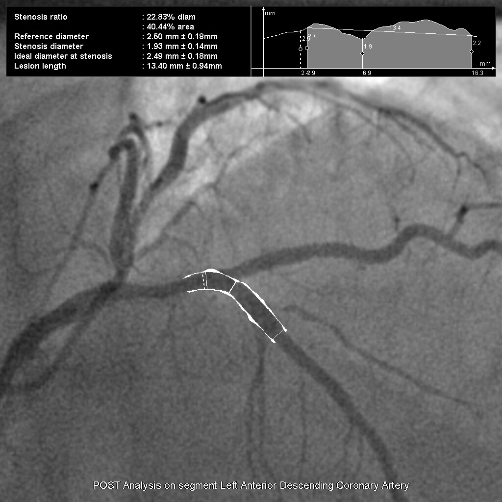 Контрольный анализ сегмента передней нисходящей артерии