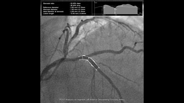 Контрольный анализ сегмента передней нисходящей артерии