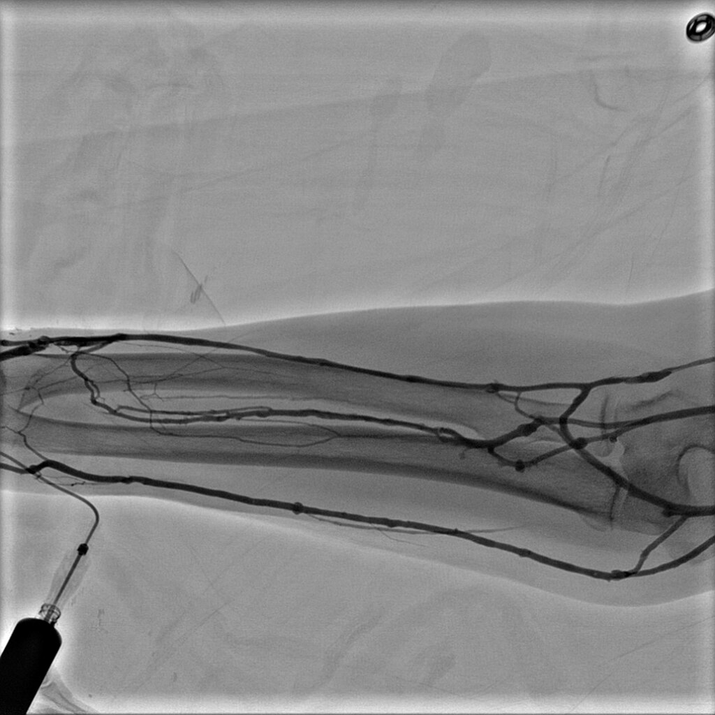Функция Innova Chase – это динамическая ангиография без субтракции при скорости съемки 5 кадров/сек, предназначенная для отслеживания движения болюса контрастного вещества с дистанционным управлением операционного стола