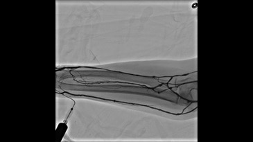 Функция Innova Chase – это динамическая ангиография без субтракции при скорости съемки 5 кадров/сек, предназначенная для отслеживания движения болюса контрастного вещества с дистанционным управлением операционного стола