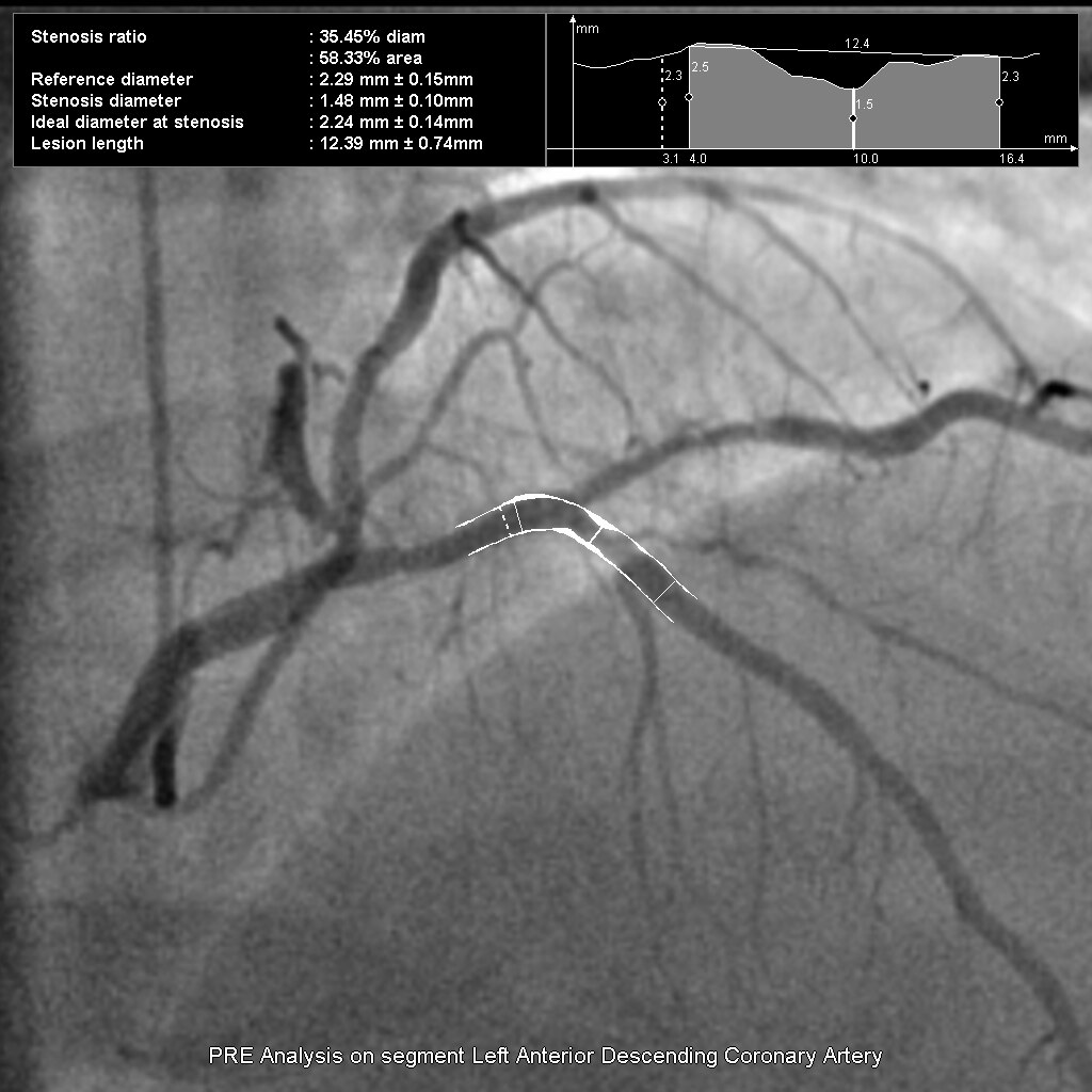 Предварительный анализ сегмента передней нисходящей артерии