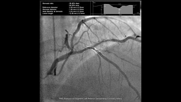 Предварительный анализ сегмента передней нисходящей артерии