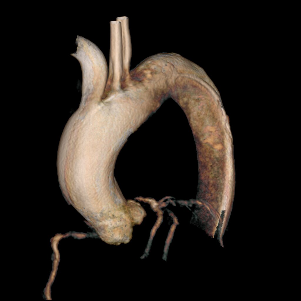 Функция Innova 3D позволяет быстро получать и реконструировать на рабочей станции AW объемные изображения анатомических структур