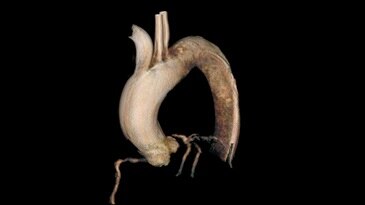 Функция Innova 3D позволяет быстро получать и реконструировать на рабочей станции AW объемные изображения анатомических структур