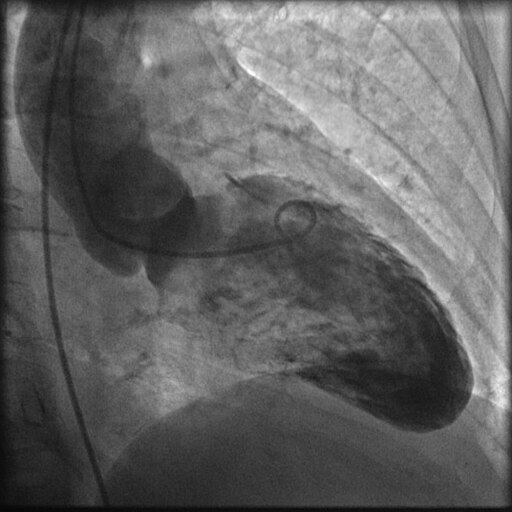 Вентрикулография