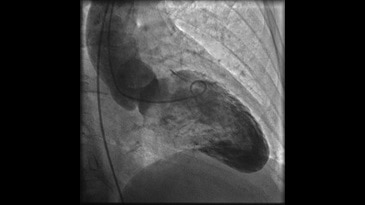 Вентрикулография